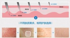 微針滾輪可以生發(fā)治禿頂嗎?有嗎?會傷害毛囊嗎?